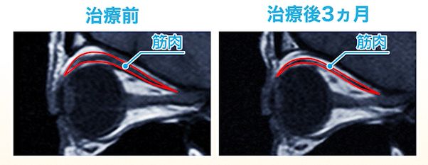 治療前と3か月後のMRI画像